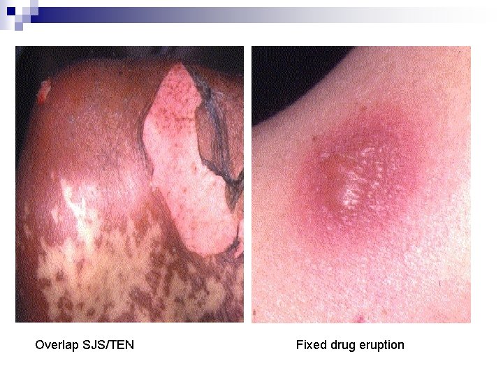 Overlap SJS/TEN Fixed drug eruption 