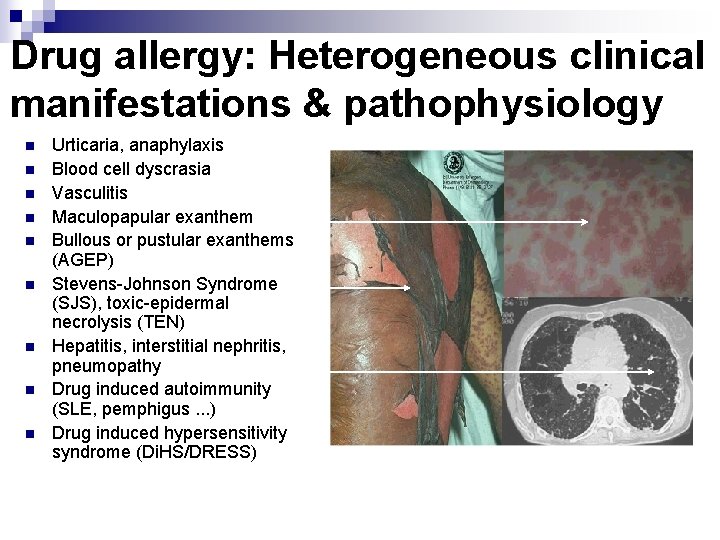 Drug allergy: Heterogeneous clinical manifestations & pathophysiology n n n n n Urticaria, anaphylaxis