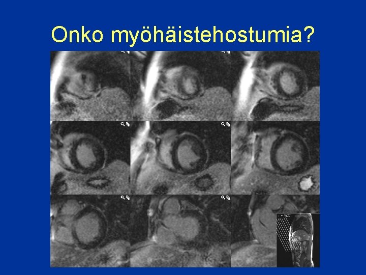 Onko myöhäistehostumia? 