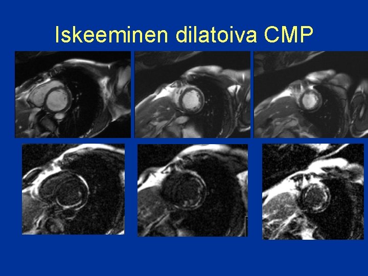 Iskeeminen dilatoiva CMP 