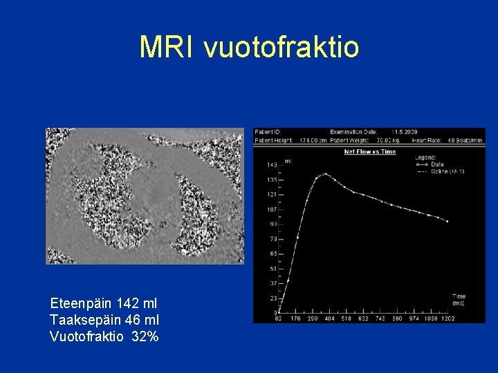 MRI vuotofraktio Eteenpäin 142 ml Taaksepäin 46 ml Vuotofraktio 32% 