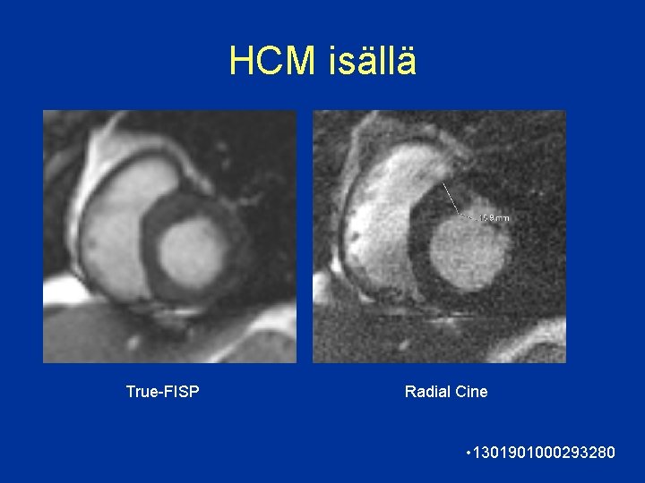 HCM isällä True-FISP Radial Cine • 1301901000293280 