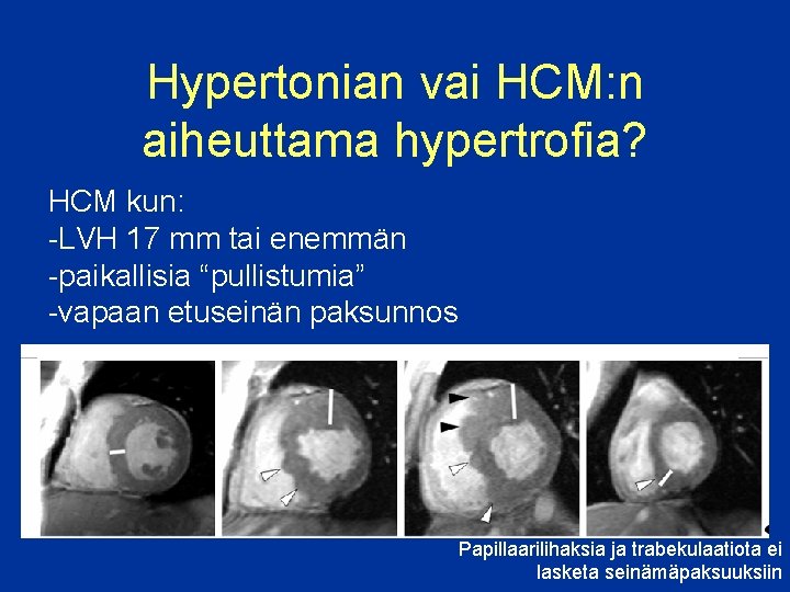 Hypertonian vai HCM: n aiheuttama hypertrofia? HCM kun: -LVH 17 mm tai enemmän -paikallisia