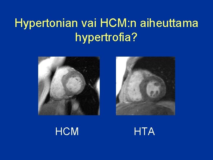 Hypertonian vai HCM: n aiheuttama hypertrofia? HCM HTA 
