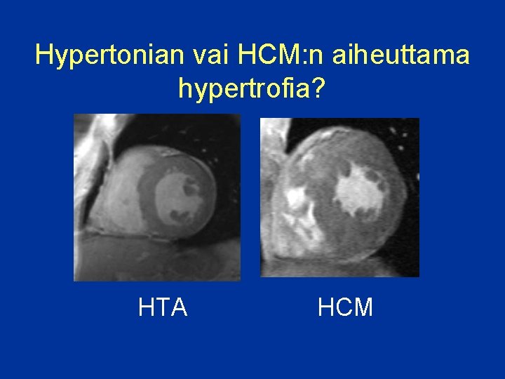 Hypertonian vai HCM: n aiheuttama hypertrofia? HTA HCM 