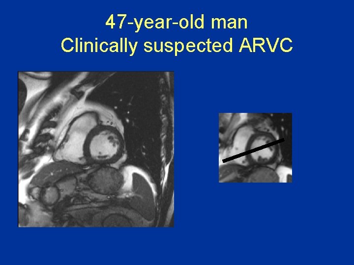 47 -year-old man Clinically suspected ARVC 