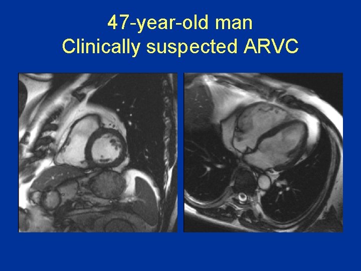 47 -year-old man Clinically suspected ARVC 