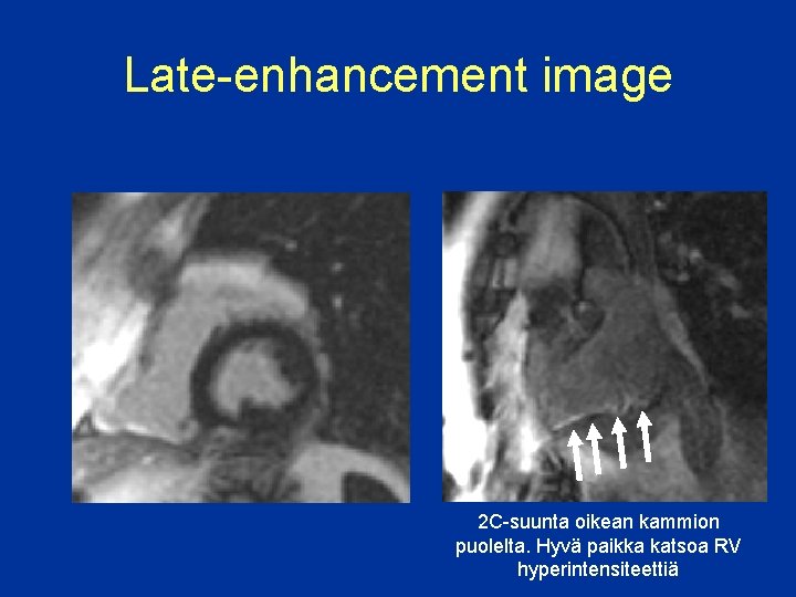 Late-enhancement image 2 C-suunta oikean kammion puolelta. Hyvä paikka katsoa RV hyperintensiteettiä 