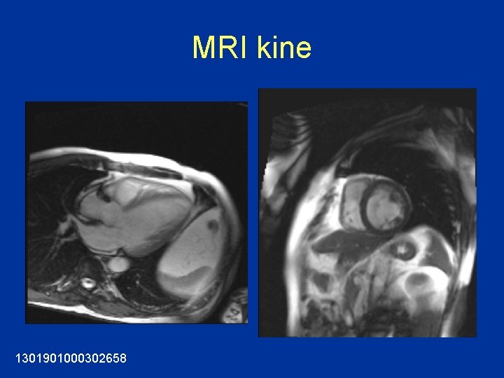 MRI kine 1301901000302658 