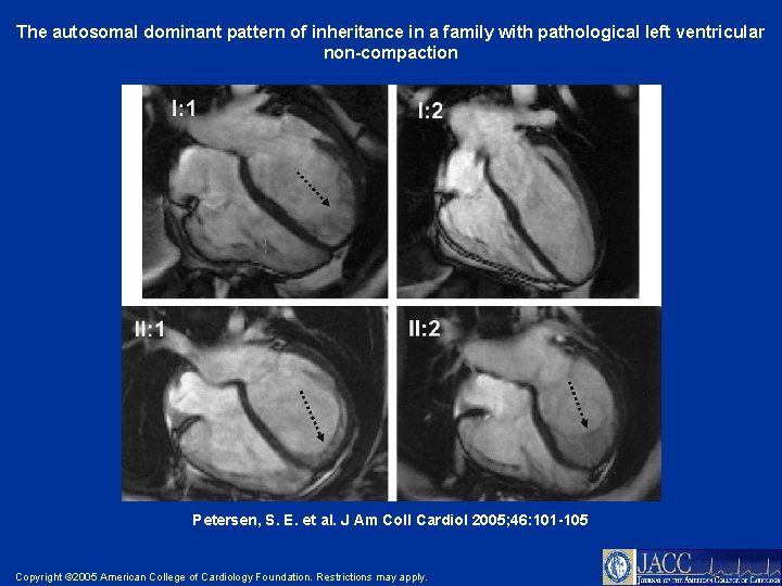 The autosomal dominant pattern of inheritance in a family with pathological left ventricular non-compaction