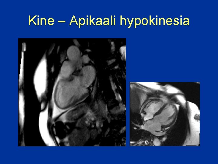 Kine – Apikaali hypokinesia 