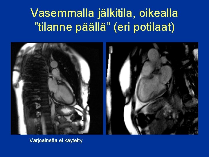 Vasemmalla jälkitila, oikealla ”tilanne päällä” (eri potilaat) Varjoainetta ei käytetty 