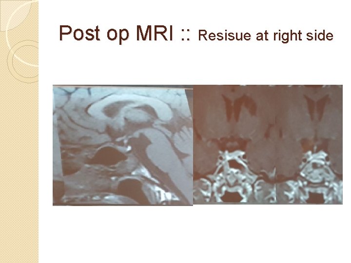 Post op MRI : : Resisue at right side 