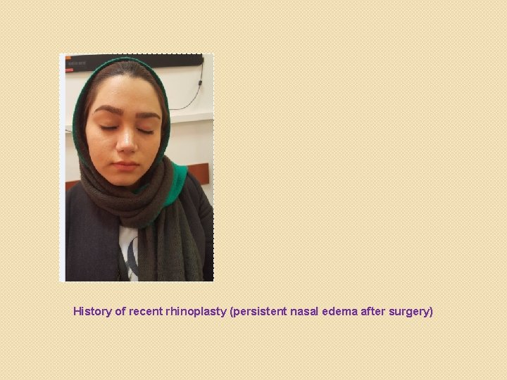 History of recent rhinoplasty (persistent nasal edema after surgery) 