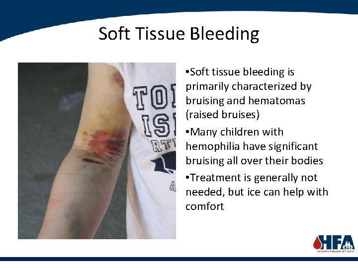 Soft Tissue Bleeding • Soft tissue bleeding is primarily characterized by bruising and hematomas