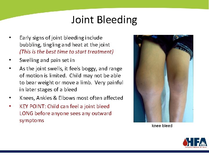 Joint Bleeding • • • Early signs of joint bleeding include bubbling, tingling and