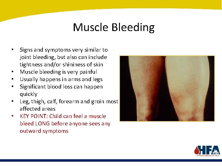 Muscle Bleeding • Signs and symptoms very similar to joint bleeding, but also can