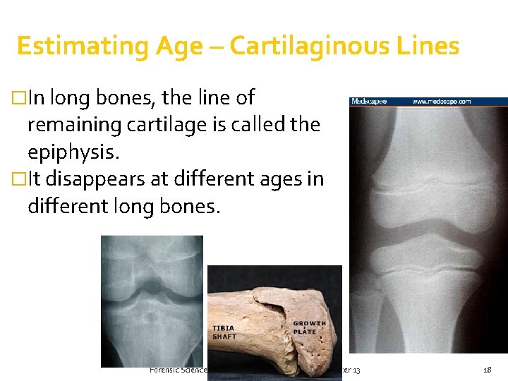 Estimating Age – Cartilaginous Lines �In long bones, the line of remaining cartilage is Estimating Age – Cartilaginous Lines �In long bones, the line of remaining cartilage is