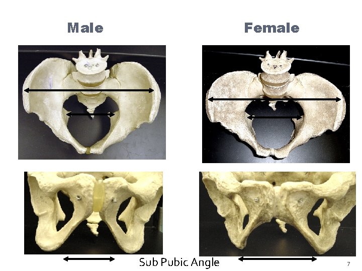 Male Female Sub Pubic Angle 7 Male Female Sub Pubic Angle 7