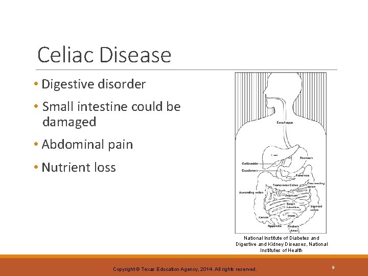 Celiac Disease • Digestive disorder • Small intestine could be damaged • Abdominal pain