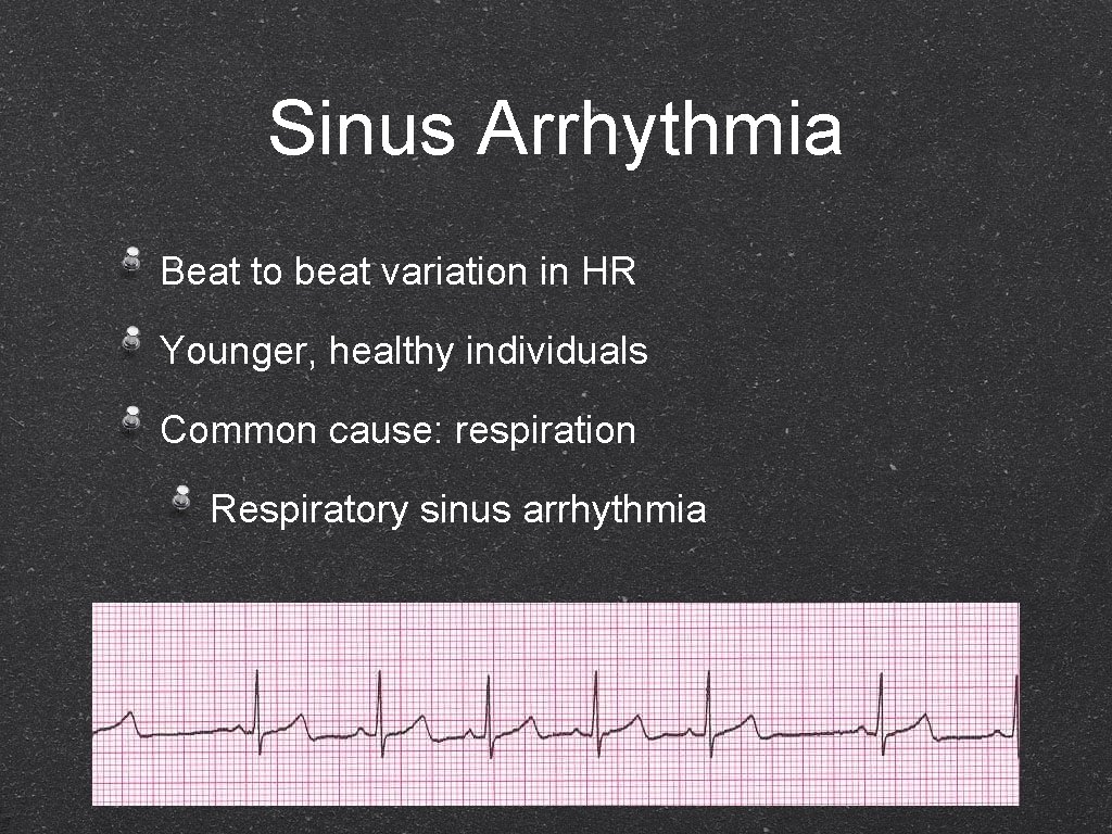 Sinus Arrhythmia Beat to beat variation in HR Younger, healthy individuals Common cause: respiration