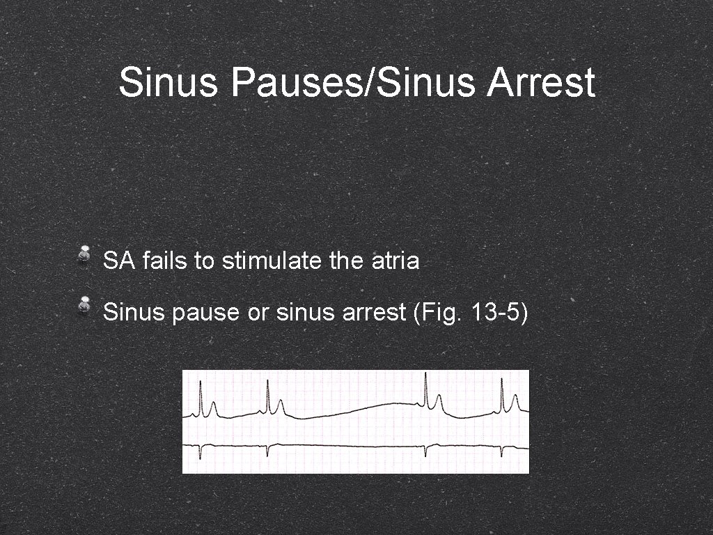 Sinus Pauses/Sinus Arrest SA fails to stimulate the atria Sinus pause or sinus arrest