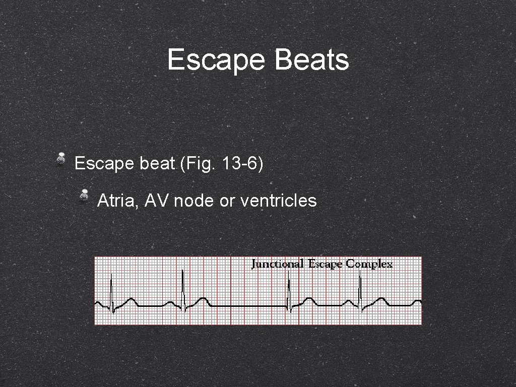 Escape Beats Escape beat (Fig. 13 -6) Atria, AV node or ventricles 