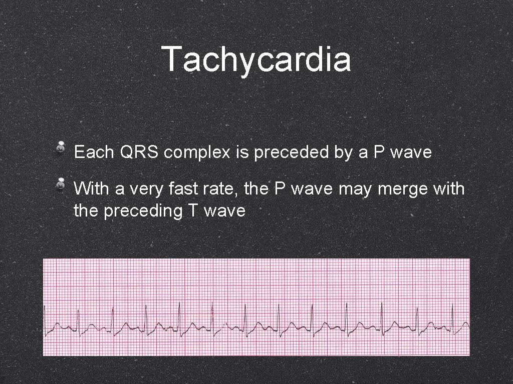 Tachycardia Each QRS complex is preceded by a P wave With a very fast