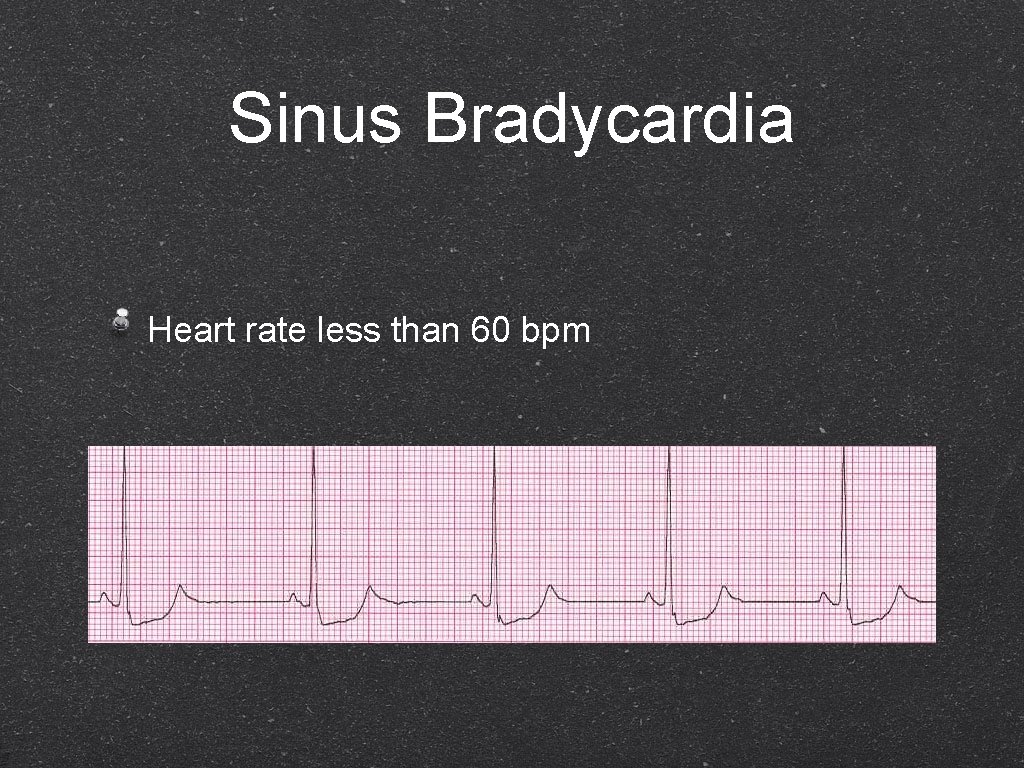 Sinus Bradycardia Heart rate less than 60 bpm 