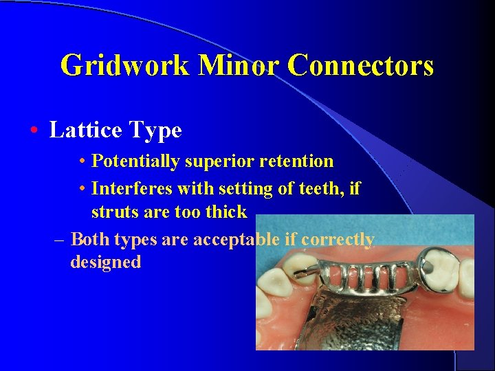 Gridwork Minor Connectors • Lattice Type • Potentially superior retention • Interferes with setting Gridwork Minor Connectors • Lattice Type • Potentially superior retention • Interferes with setting