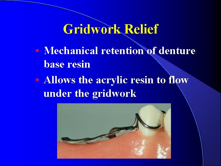 Gridwork Relief • Mechanical retention of denture base resin • Allows the acrylic resin Gridwork Relief • Mechanical retention of denture base resin • Allows the acrylic resin