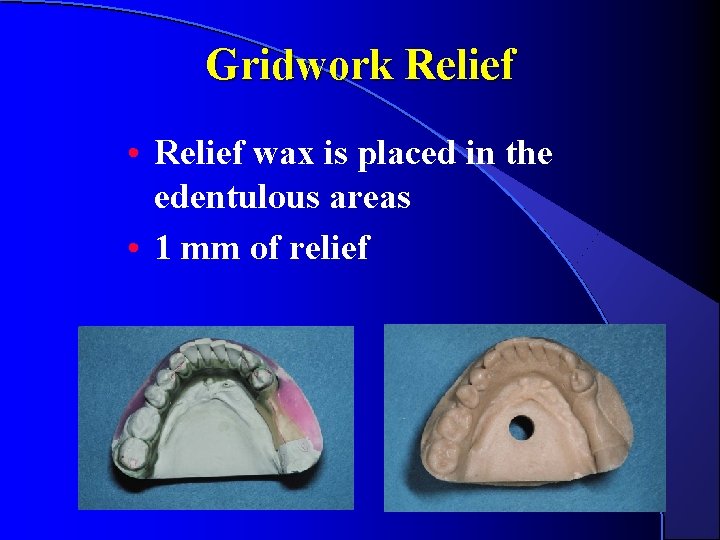 Gridwork Relief • Relief wax is placed in the edentulous areas • 1 mm Gridwork Relief • Relief wax is placed in the edentulous areas • 1 mm
