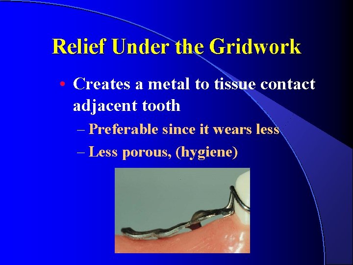 Relief Under the Gridwork • Creates a metal to tissue contact adjacent tooth – Relief Under the Gridwork • Creates a metal to tissue contact adjacent tooth –