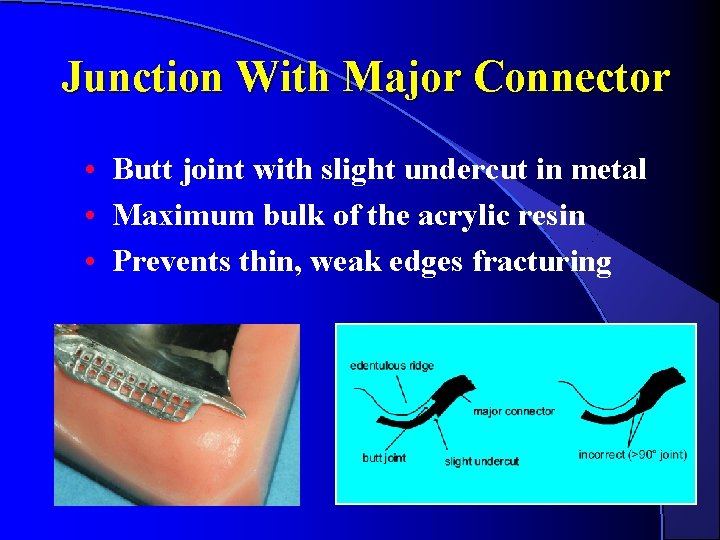 Junction With Major Connector • Butt joint with slight undercut in metal • Maximum Junction With Major Connector • Butt joint with slight undercut in metal • Maximum