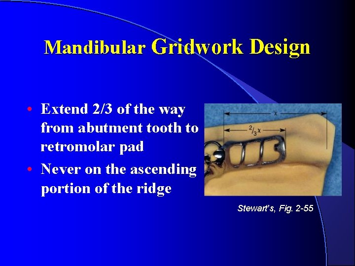 Mandibular Gridwork Design • Extend 2/3 of the way from abutment tooth to retromolar Mandibular Gridwork Design • Extend 2/3 of the way from abutment tooth to retromolar