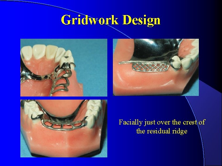Gridwork Design Facially just over the crest of the residual ridge Gridwork Design Facially just over the crest of the residual ridge