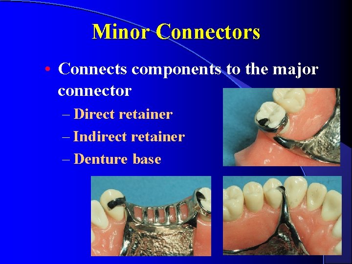 Minor Connectors • Connects components to the major connector – Direct retainer – Indirect Minor Connectors • Connects components to the major connector – Direct retainer – Indirect