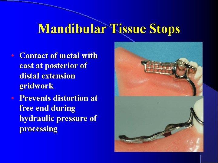 Mandibular Tissue Stops • Contact of metal with cast at posterior of distal extension Mandibular Tissue Stops • Contact of metal with cast at posterior of distal extension