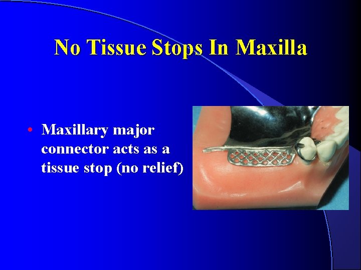 No Tissue Stops In Maxilla • Maxillary major connector acts as a tissue stop No Tissue Stops In Maxilla • Maxillary major connector acts as a tissue stop