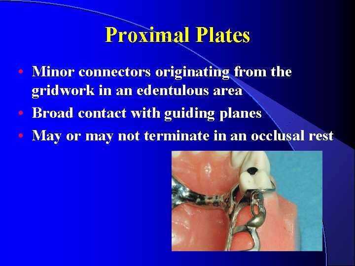 Proximal Plates • Minor connectors originating from the gridwork in an edentulous area • Proximal Plates • Minor connectors originating from the gridwork in an edentulous area •