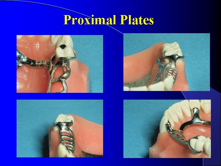 Proximal Plates Proximal Plates