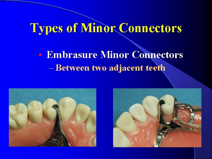 Types of Minor Connectors • Embrasure Minor Connectors – Between two adjacent teeth Types of Minor Connectors • Embrasure Minor Connectors – Between two adjacent teeth