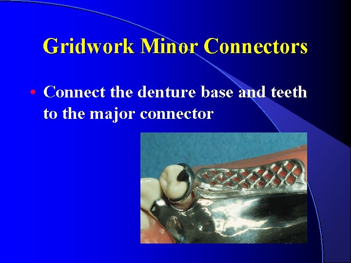 Gridwork Minor Connectors • Connect the denture base and teeth to the major connector Gridwork Minor Connectors • Connect the denture base and teeth to the major connector