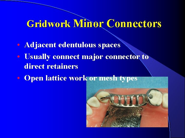Gridwork Minor Connectors • Adjacent edentulous spaces • Usually connect major connector to direct Gridwork Minor Connectors • Adjacent edentulous spaces • Usually connect major connector to direct