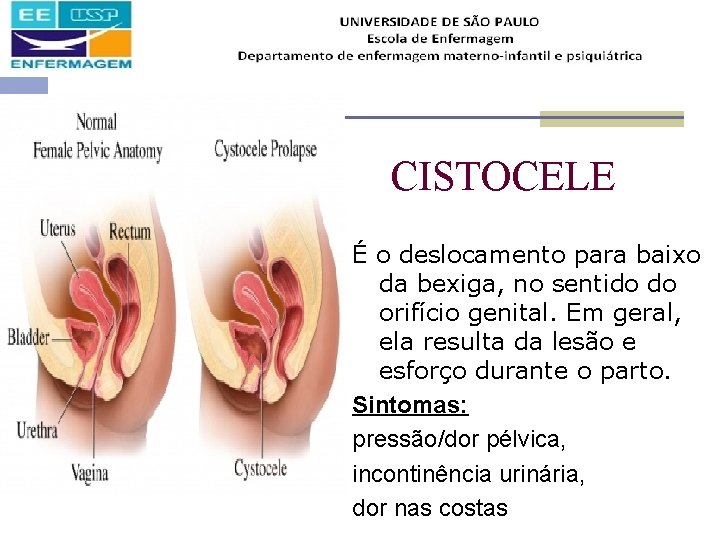 CISTOCELE É o deslocamento para baixo da bexiga, no sentido do orifício genital. Em