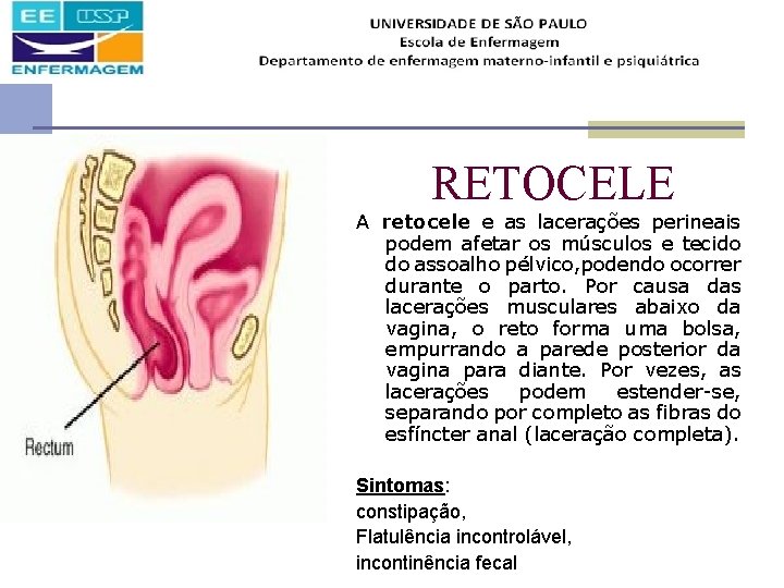 RETOCELE A retocele e as lacerações perineais podem afetar os músculos e tecido do