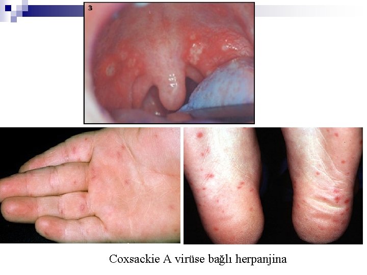 Coxsackie A virüse bağlı herpanjina 