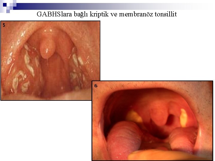 GABHSlara bağlı kriptik ve membranöz tonsillit 
