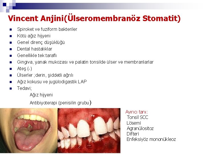 Vincent Anjini(Ülseromembranöz Stomatit) n n n n n Spiroket ve fuziform bakteriler Kötü ağız