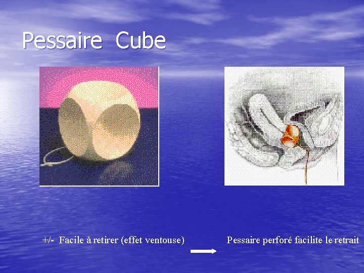 Pessaire Cube +/- Facile à retirer (effet ventouse) Pessaire perforé facilite le retrait 